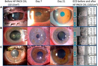 Accelerated high fluence photoactivated chromophore for infectious keratitis—corneal cross-linking (PACK-CXL) at the slit lamp: a pilot study